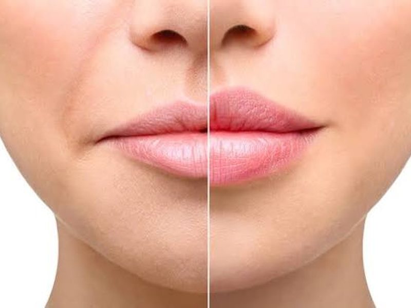 Dermal filler treatment